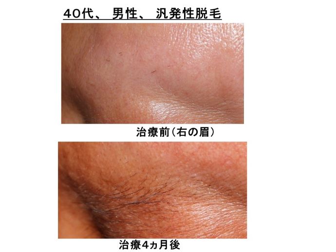 円形脱毛症　病院